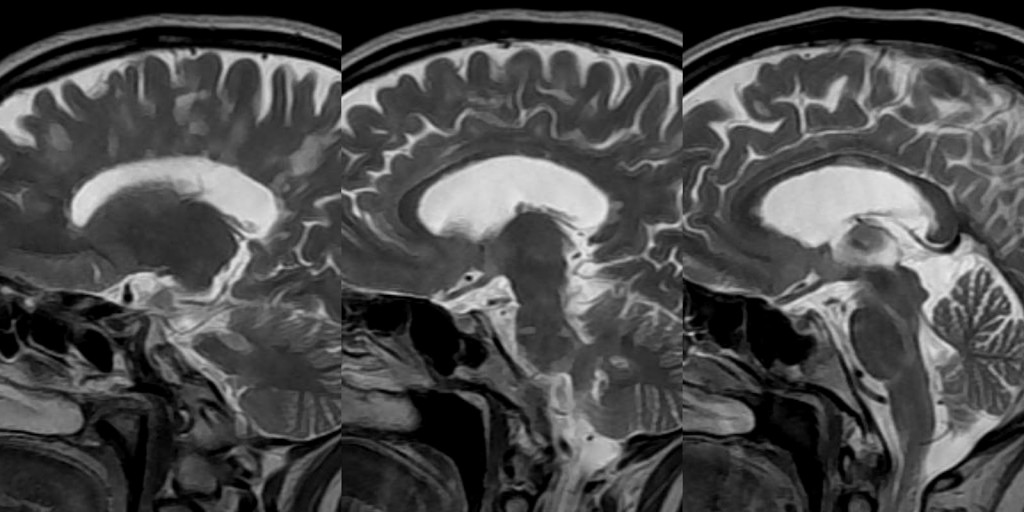 Brain scans of an M.S. patient showing demyelination